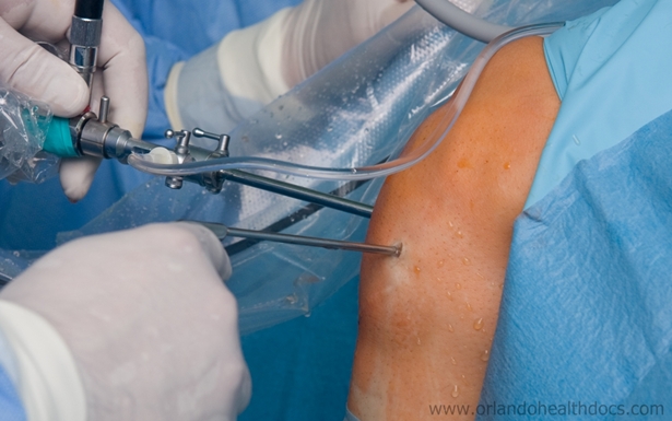 Shoulder Arthroscopy – Rotator Cuff Tear repair from shoulder specialists in Bangalore